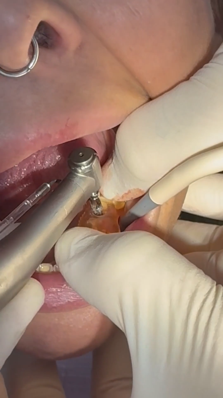 Curso implantes - Actuación 1